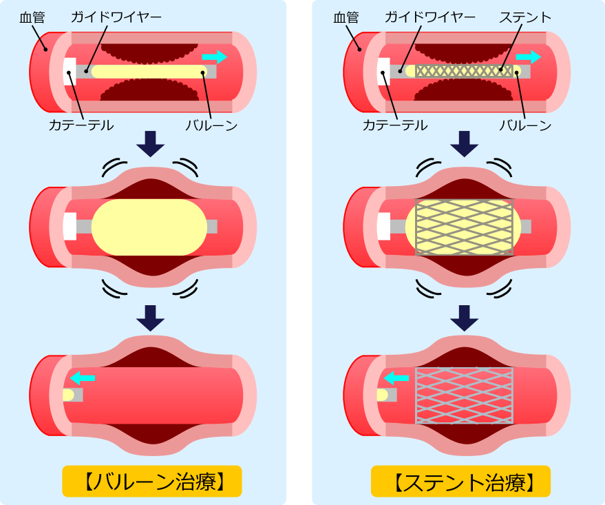 evt と pta の 違い