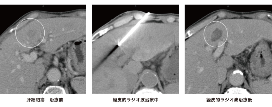 経皮的ラジオ波治療