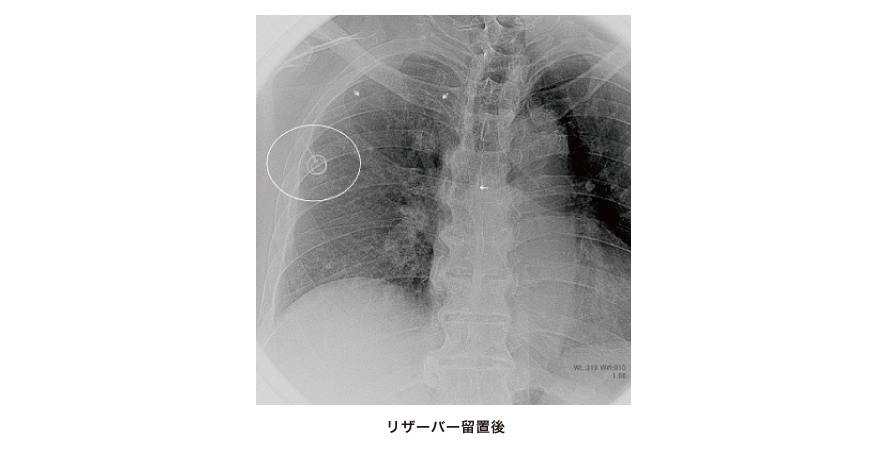 リザーバー留置