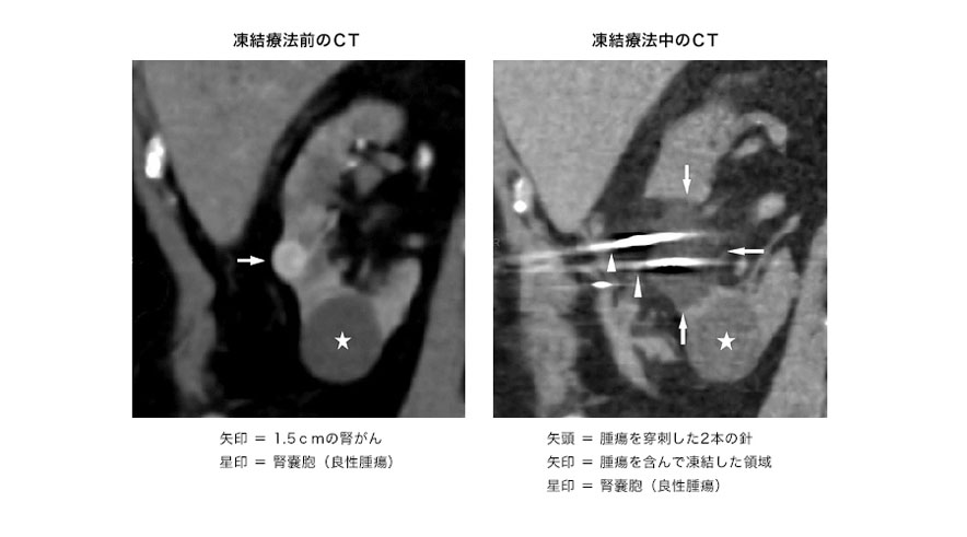 凍結療法