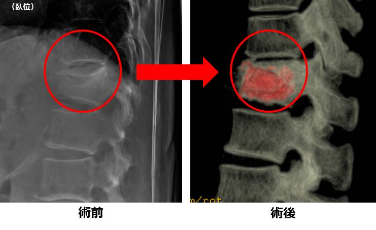 バルーン椎体形成術のレントゲン像