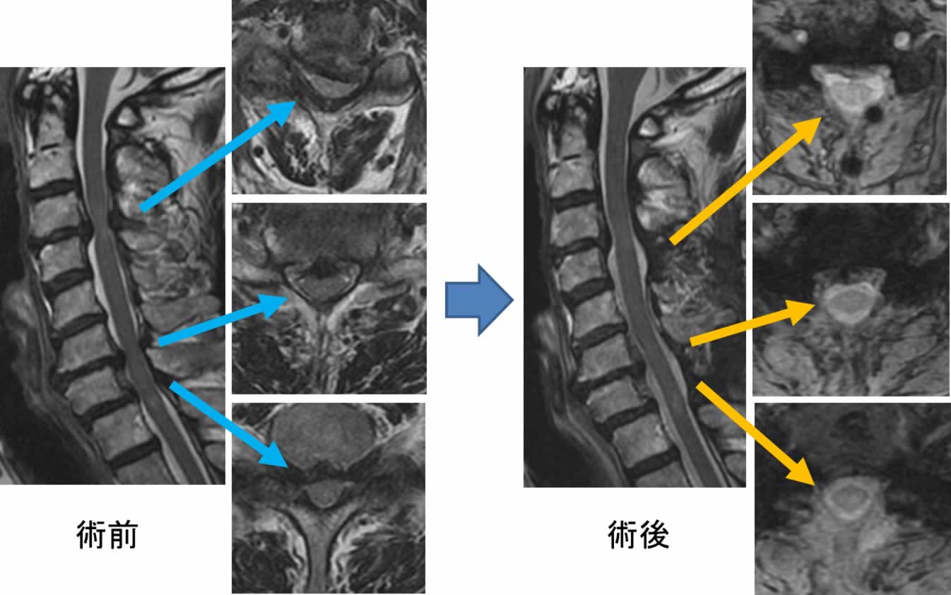 頸部脊髄症に対する選択的椎弓切除術