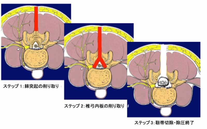 筋肉温存型腰椎椎弓間除圧術（MILD法）