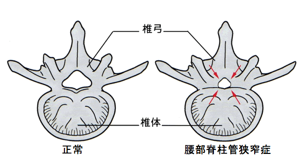 腰部脊柱管狭窄症のシェーマ